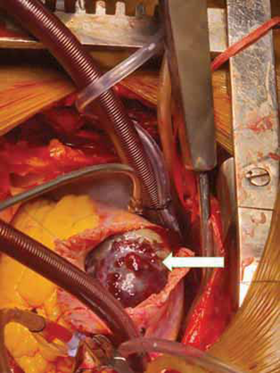 Visualization of mass on opening right atrium (RA) (white arrow).