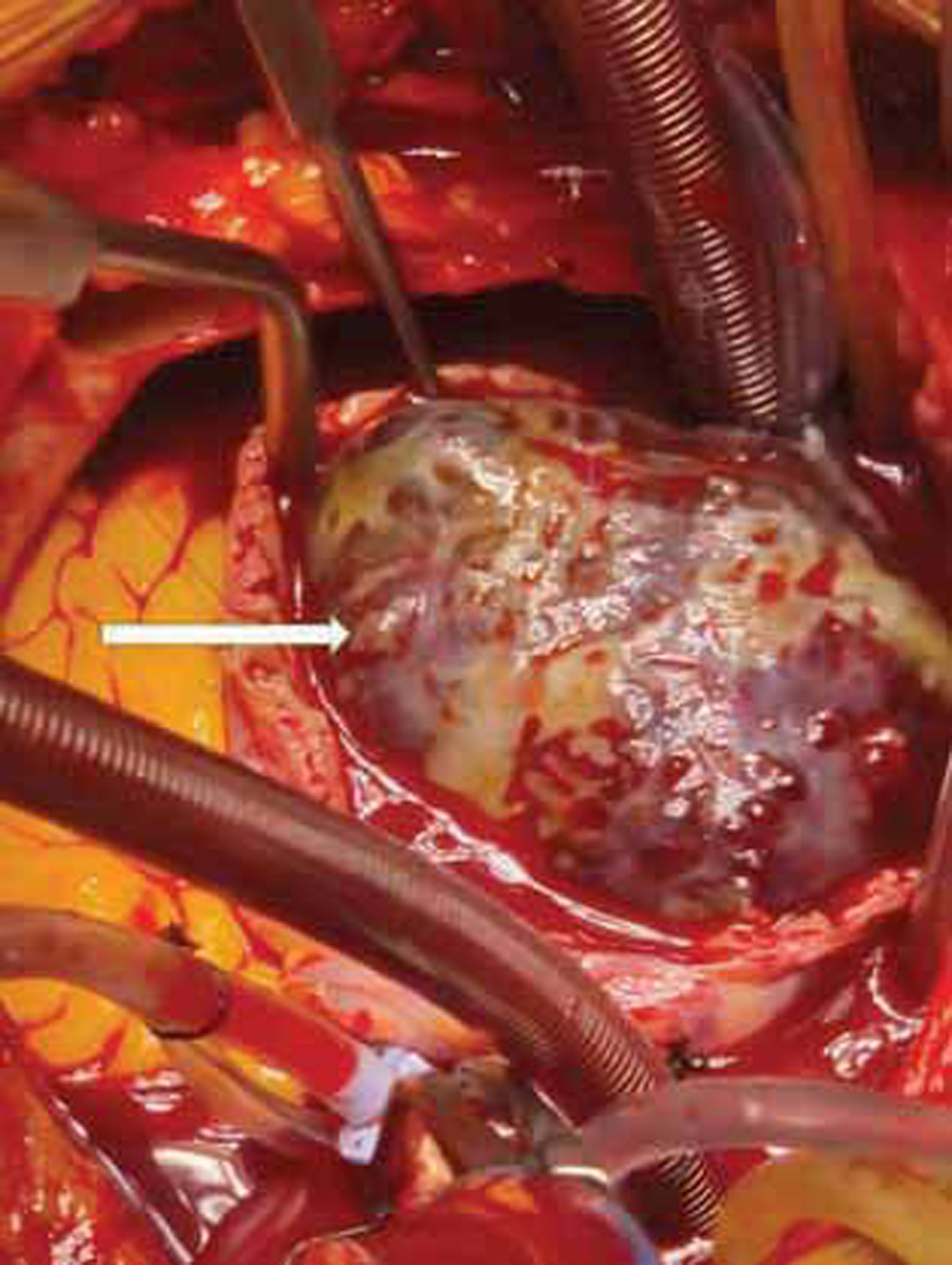 Mass shown occupying whole of right atrium (RA) (white arrow).