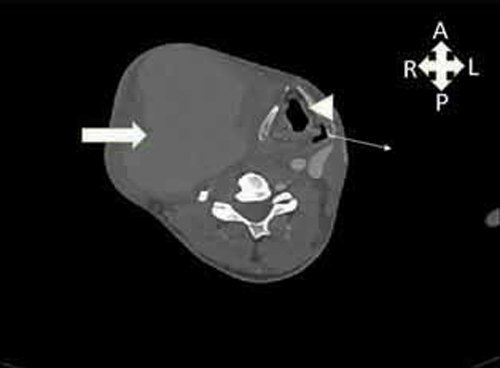 Contrast CT image of neck showing pseudoaneurysm and its relation to surrounding structures. Block arrow—pseudoaneurysm; arrowhead—trachea; line arrow—esophagus.