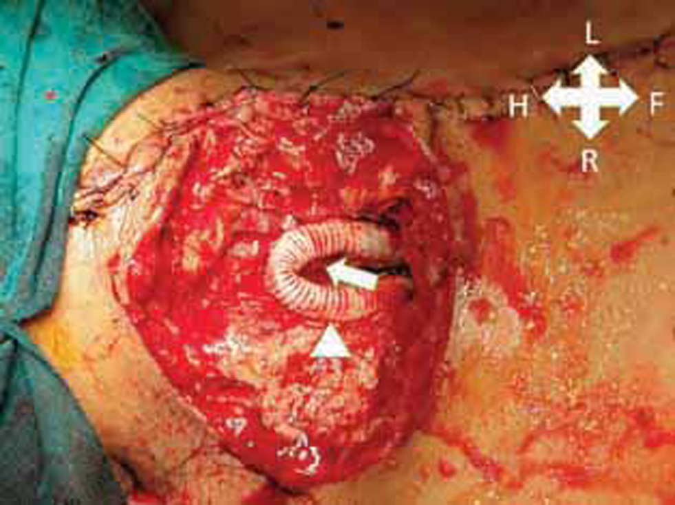 Operative image showing dacron Y graft anastomosed to right subclavian artery (RSCA) (arrowhead) and right common carotid artery (RCCA) (arrow) from ascending aorta, postpseudoaneurysm excision.