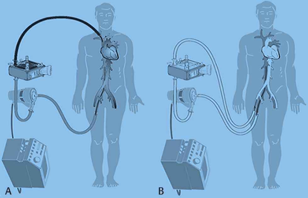 Extracorporeal membrane oxygenation (ECMO) in the treatment of respiratory failure during COVID-19