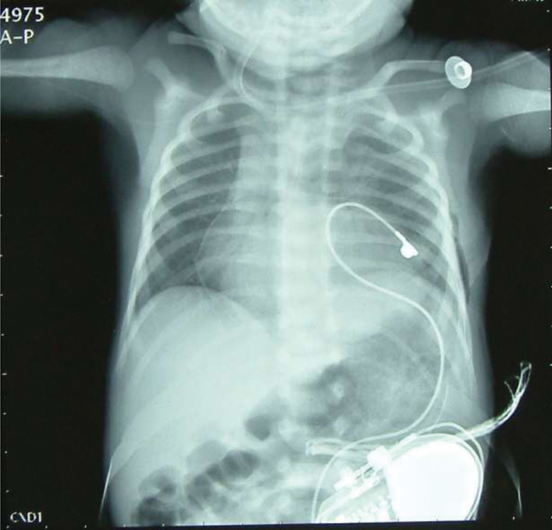 Postoperative chest radiograph showing pacemaker device in left pleural cavity with a single epicardial pacing lead in situ.