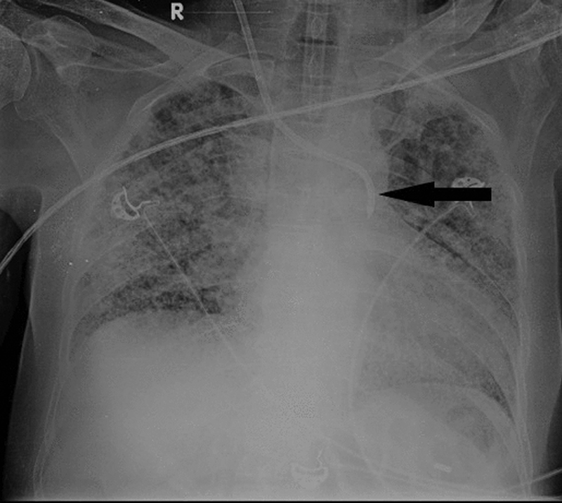 Chest X-ray showing the hemodialysis catheter lying in the arch of aorta (arrow).