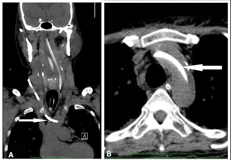 (A) Computed tomography angiogram (CTA) showing hemodialysis catheter coursing from the right side of the neck into the brachiocephalic trunk and the aortic arch (arrow). (B) Hemodialysis catheter lying in the aorta (arrow).
