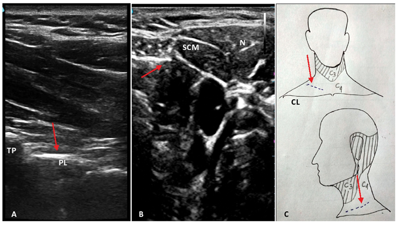 Sonoanatomy and dermatomal supply of neck with incision line. (A) Sonoanatomy of cervicothoracic (C7-T1) paravertebral space with arrow indicating the space for intended block. (B) Sonoanatomy for superficial cervical plexus block with arrow indicating the plexus. (C) Schematic diagram showing the sensory supply of anterolateral neck with incision line marked by the arrow. CL, clavicle; N, needle; PL, parietal pleura; SCM, sternocleidomastoid; TP, transverse process of C7 vertebra.