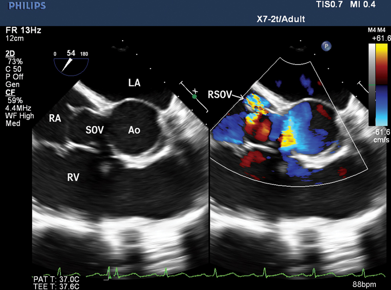 Two-dimensional transesophageal echocardiography (2D-TEE) mid-esophageal right ventricle (RV) inflow-outflow view with color comparison revealing sinus of Valsalva (SOV) draining into right atrium (RA) with characteristic windshock appearance. LA, left atrium; RV, right ventricle; AO, aorta.