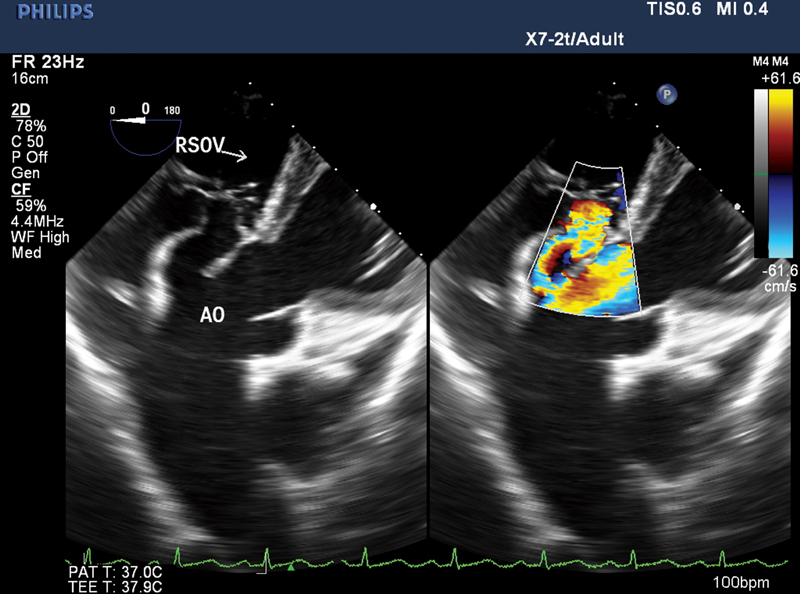 Two-dimensional transesophageal echocardiography (2D-TEE) deep transgastric view with color comparison confirming rupture sinus of Valsalva (RSOV) and normal aorta (AO).