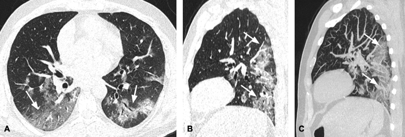 (A–C) Axial (A) and sagittal (B) computed tomography (CT) scan images in lung window and sagittal thin maximum intensity projection (MIP) image in a patient diagnosed with COVID-19 pneumonia showing ground-glass opacities and consolidation (arrows) predominantly involving the posterior segments of bilateral lower lobes. The upper lobes and the nondependent areas of bilateral lungs are relatively free of disease.