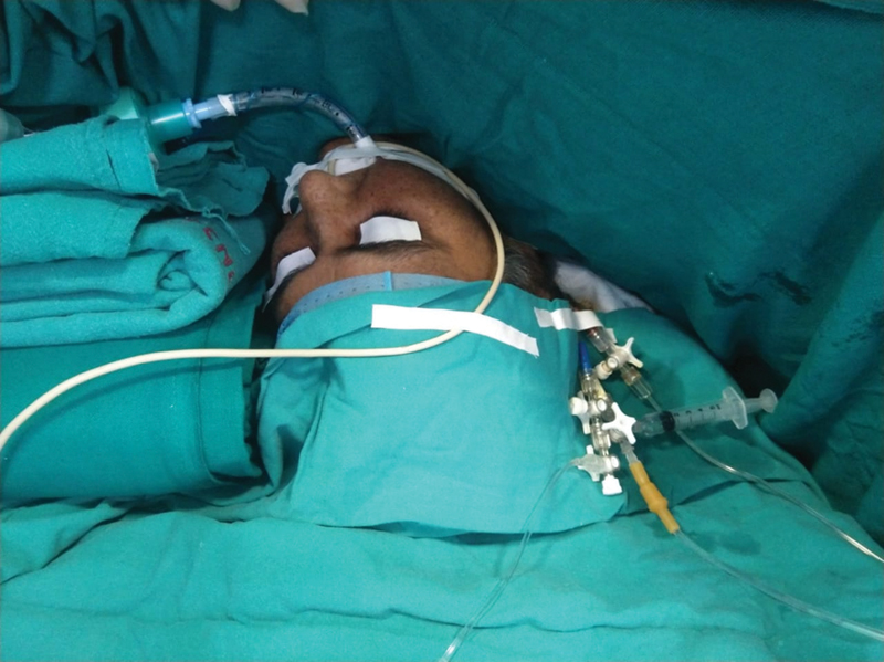 Patient anesthetized with a ProSeal LMA mask on the operating table.