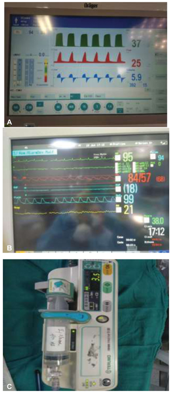 (A) Mechanical ventilator during pectoralis major flap reconstruction perioperative when blood pressures came down on the monitor. (B) Monitor screen. (C) Noradrenaline injection started in intensive care unit with endotracheal tube in situ, whereas intraoperative there was no inotrope sepsis in ICU warrants starting noradrenaline.