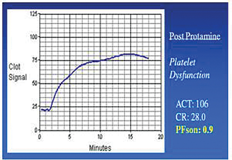 Sonoclot PFson curve decreased with thrombocytopenia. ACT, activated coagulation time; CR, clot rate.
