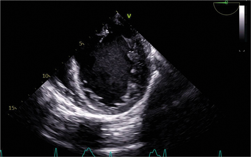 A two-chamber magnetic resonance view on transesophageal echocardiography showing left ventricular hypertrophy as seen in preoperative period with the left atrium dilated, ejection fraction < 35%, SAV ME showed a tricuspid aortic valve. ME, midesophageal view; SAV, shorts in aortic valve.