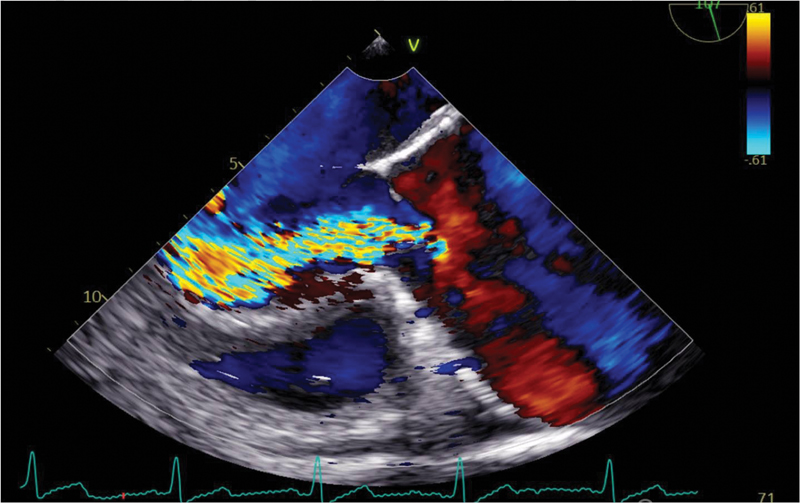 Preoperative AS and aortic regurgitation (AR) jet seen in the midesophageal long axis view. The AR jet is severe occupying whole of the left ventricular outflow tract with a severe AS as well. AS, aortic stenosis.