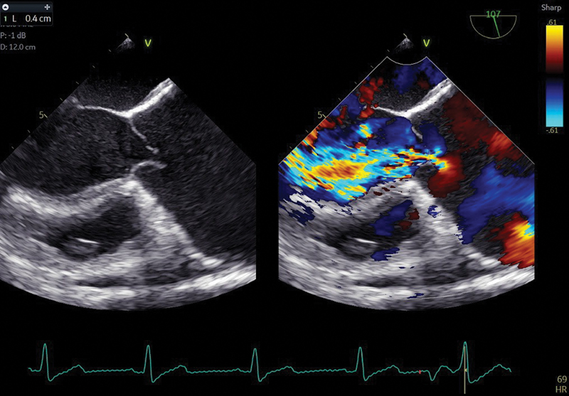 Preoperative measurement of vena contracta in midesophageal long axis view shows the aortic regurgitation severity as severe.
