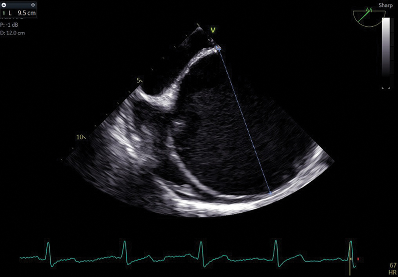 Preoperative aortic measurement in operative room across the ascending aorta > 5.0 cm, which makes it a candidate for the replacement of the aneurysm small ascending aorta.
