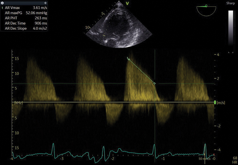 Preoperative measurement of gradient of aortic regurgitation and AS, showing the gradients both peak and mean as high.