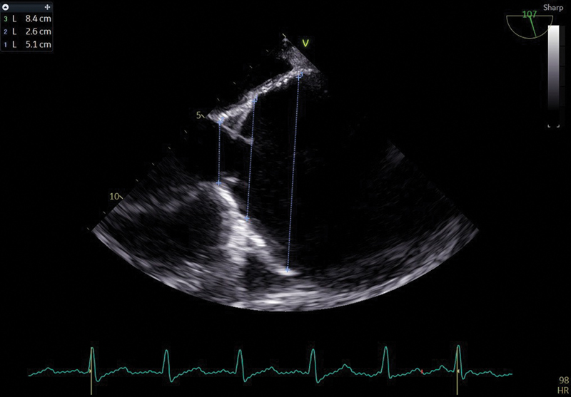 Preoperative measurement of aortic annulus and aorta in midesophageal long axis view across the aortic annulus, the sinotubular junction, and the ascending aorta.