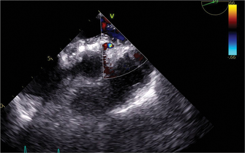 Coronary blood flow seen on echocardiography in postoperative period, across the left coronary ostia of the aortic valve from RCCC and LCCC. No paraortic hematoma or abscess are detected. RCCC, right coronary cusp commissure; LCCC, left coronary cusp commissure.
