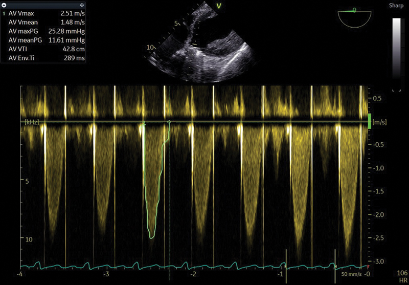 Postoperative gradient measurement across the aortic valve remains high but shows no aortic regurgitation jets. The prosthetic shadow is showing anterior wash. Strong prosthetic graft reflectors are seen.
