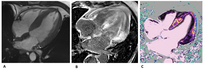 (A) SSFP four-chamber view showing left ventricular and left atrial hypertrophy. (B) Late-gadolinium enhancement distributed in both septum and atrium-ventricular walls.(C) T1-mapping native significantly elevated compatible with fibrosis. SSFP, steady state free precession.