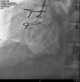 Complete occlusion of right coronary artery post-revascularization.