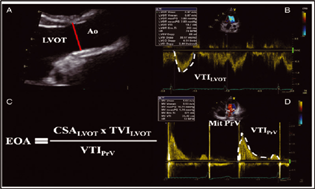 Doppler evaluation of mitral prosthesis.