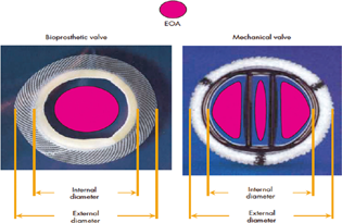 Comparison of bioprosthetic valve and a bileaflet mechanical valve in fully opened leaflet position. Pink color is effective orifice area (EOA), clearly it is lesser than internal geometric area (IGA).