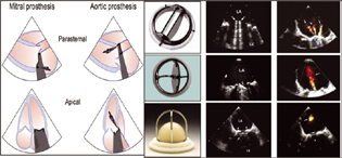 Types of prosthetic shadow seen on TEE, with a particular valve.