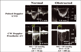 Pulse wave and continuous wave doppler across LVOT and prosthetic valve showing comparison of normal and obstructed prosthetic aortic valve.