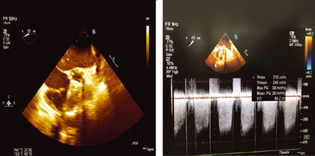 CW Doppler across aortic valve showing high mean gradient across aortic valve. CW: Continuous Wave.