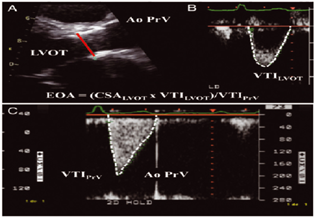 Parasternal long-axis view for derivation of LVOT diameter and subsequently.