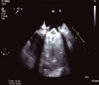 Preprocedure stuck mitral valve.