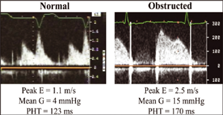 Continuous wave interrogation across mitral valve showing indices of obstruction across mitral valve