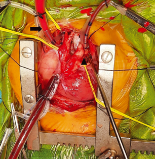 Establishment of CPB with aortic cannulae in the innominate artery and DTA (arrow: cannula into the innominate artery; arrowhead: cannula into the DTA).