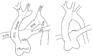 Schematic representation of aortic arch reconstruction.