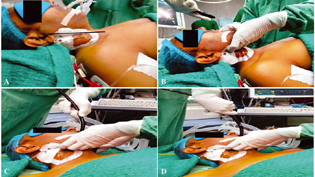 Steps of SORT maneuver for transesophageal echocardiography (TEE) probe insertion. (A) (S)niffing position; (B) Anteflexed probe (O)rientation with jaw thrust; (C) Head (R)otation to the left; (D) (T)wisting movement with probe advancement.