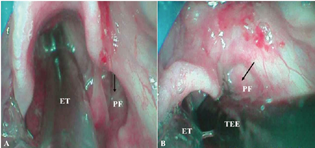 Video laryngoscopic images of SORT-assisted TEE probe insertion. (A) Open pyriform fossa (indicated by black arrow) without SORT maneuver; (B) Obliterated pyriform fossa (indicated by black arrow) after SORT maneuver assisting smooth TEE probe insertion. ET, endotracheal tube; PF, pyriform fossa; TEE, transesophageal echocardiography probe.