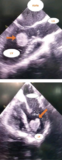 Echocardiography—four-chamber view showing left ventricular mass. LA, left artery; LV, left ventricle.