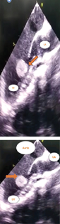 Echocardiography—parasternal long axis view showing left ventricular mass. LV, left ventricle; LA, left artery.