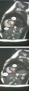 Cardiac magnetic resonance imaging showing left ventricular mass. LA, left artery; LV, left ventricle; RV, right ventricle.