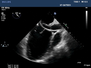 Fluoroscopy showing catheter across anterior mitral leaflet perforation.