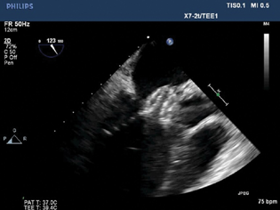 Two-dimensional transesophageal echocardiography showing atrial septal occluder device placement across anterior mitral leaflet and aortic root perforation.