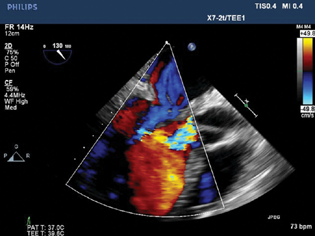 Transesophageal echocardiography color Doppler showing no residual mitral regurgitation and a significant reduction in aortic regurgitation after device closure.