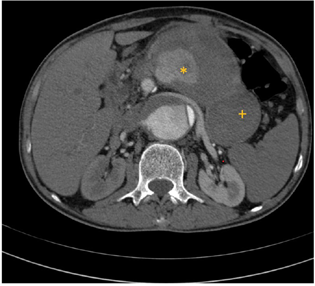 Computed tomography angiography axial image showing splenic artery pseudoaneurysm (*) with peripheral thrombus (+).