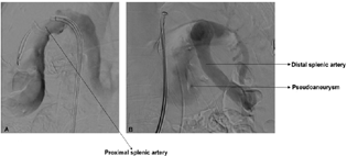 Digital subtraction angiography images: (A) Lateral oblique and (B) anteroposterior projection showing origin of pseudoaneurysm from splenic artery.