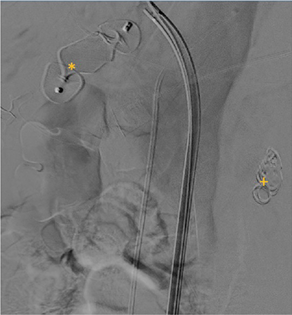 Check digital subtraction angiography showing coils (+) and plug (*) in distal and proximal portion of splenic artery, respectively, with complete exclusion of pseudoaneurysm.