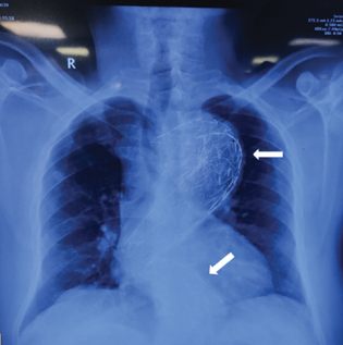 Preoperative chest X-ray of the patient showing two stents (white arrow) in the descending thoracic aorta placed during the first thoracic endovascular aortic repair procedure for type B aortic dissection.