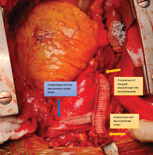 Image showing the anastomotic sites of the 14mm graft from ascending aorta to innominate artery (yellow arrows) and 9mm graft to left common carotid artery (blue arrow).
