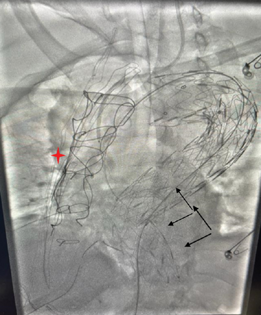 Fluoroscopy image taken in cath laboratory showing the two aortic stents (black arrows) in situ along with sternal wires (red star) in the patient post-debranching surgery.