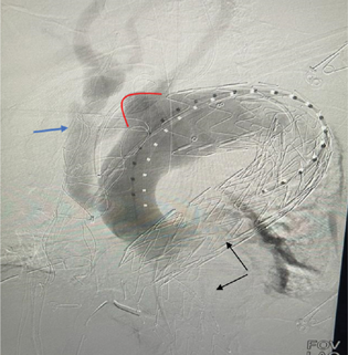 Contrast-enhanced fluoroscopy image of the aorta demonstrating the bulge in the arch of the aorta-pseudoaneurysm (red outline and the filling up of the debranched aortic arch vessels [blue arrow]).